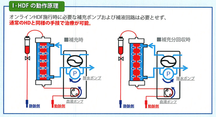 IHDF　原理